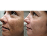 (peelling 3d) 10 Ml+ Acido Retinoico 40%+ Tioglicolico 10%