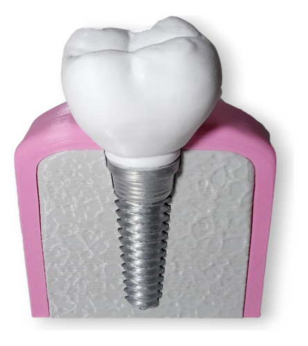 Modelo Molar -implante Dental- Para Estudio Odontológico