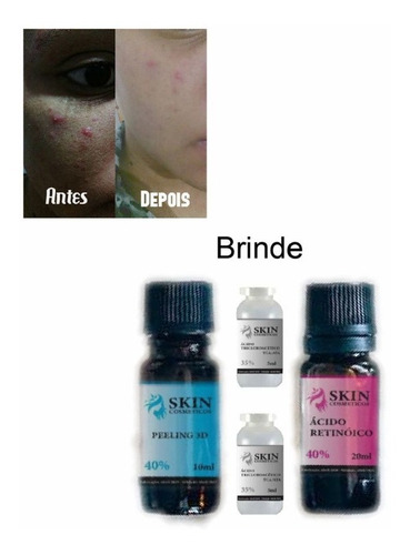 Melasma (retinoico 40% 10ml + Peeling 3d 10ml + Tca 10ml)