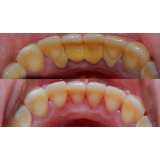 Limpieza Dental Con Ultrasonido,  Sin Envío A Domicilio