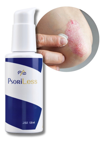 Creme Para Psoríase Psoriless - Formulado Estados Unidos