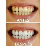 Blanqueamiento Dental + Limpieza Con Ultrasonido Y Fluor