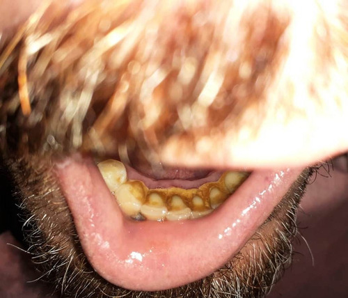 Limpieza Dental Odontológica Con Ultrasonido Remoción  Sarro