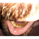 Limpieza Dental Odontológica Con Ultrasonido Remoción  Sarro