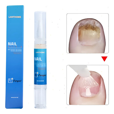 Bolígrafo Con Solución Antimicosis Y Anti Hongos En Las Uñas | MercadoLibre