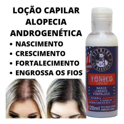 Tratamento Capilar Para Calvície Tônico Anti Alopécia Areata