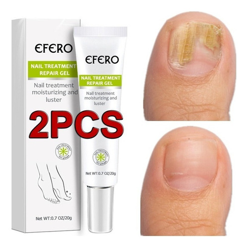 Gel Para Eliminar Hongos En Las Uñas De Los Pies, 2 Unidades