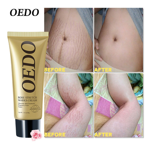 Crema De Eliminación Esencial Para Estrías De C Stretch Mark