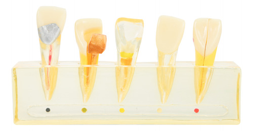 Modelo De Patología Dental Para Mostrar La Endodoncia Fronta