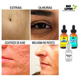 Cicatriz/olheira/melasma/estria (retinoíco+tca+3d) 10ml