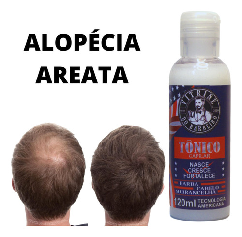 Loção P/ Calvície Careca Nasce Cresce Cabelo Barba Original!