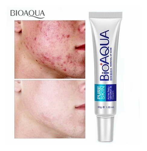 Crema Bioaqua Skin Anti Acné Quita Espinillas Reduce Grasa