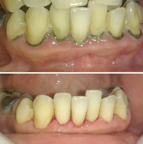 Limpieza Dental Ultrasonido+ Brochita + Flúor Profesional