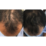 Tratamento Para Calvície Cura Careca Nasce Cabelo Em 30 Dias