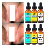 Completo (peeling 3d 20ml, Retinoíco 40% 20ml, Tca 35% 20ml)