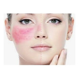 Tratamiento Facial Para Rosacea, Sesion,  Villa Crespo. 