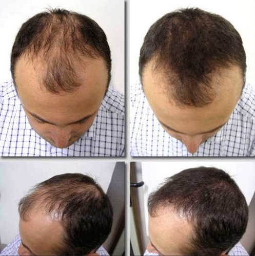 Rodillo Para Estimular Crecimiento Regenerar Cabello Barba