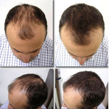 Rodillo Para Estimular Crecimiento Regenerar Cabello Barba