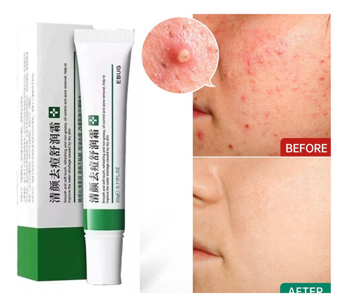 Tratamento Para Espinhas Efetivo Anti Acne Melasma Oferta