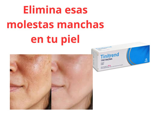 Elimina Manchas De La Cara Con Ácido Retinoico (tretinoína)