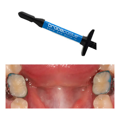 Bracepaste Resina Cementar Bandas De Ortodoncia Con Tubos | Envío gratis
