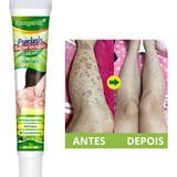  Pomada Para Dermatite Atópica Dermatite De Contato Derma