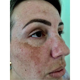 Experimente Peeling 3d 40% 5ml + Ácido Retinoico 40% 5ml)