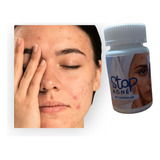 Stop Acne Formulacion Especifica Para El Acne 