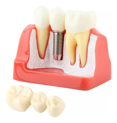 1 Pieza De Demostración Dental De Resina, Modelo Dental
