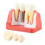 1 Pieza De Demostración Dental De Resina, Modelo Dental