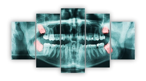 Quadros Decorativos Mfd Raio X Dentes Dentista