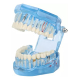 Dientes Dentales Modelo Acrílico Azul Transparente.