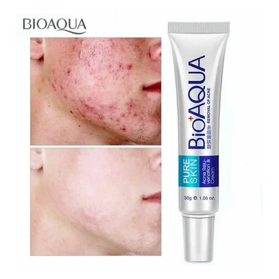 Crema Especial Anti Acné Granos Espinillas Puntos Negros Tipo De Piel Todo Tipo De Piel | Envío gratis