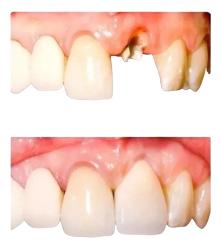 Dentes Postiço De Resina Avulso + Massa Fixadora