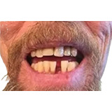 Dentes Provisórios A2, De Encaixe, Inferiores+ Massa Fixar