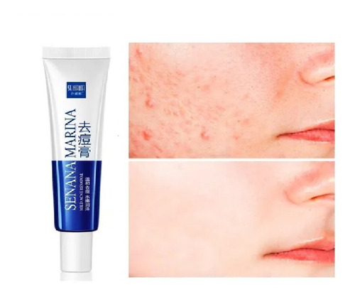 Crema Disminuye Acne Espinillas Senana Marina Anti Acné