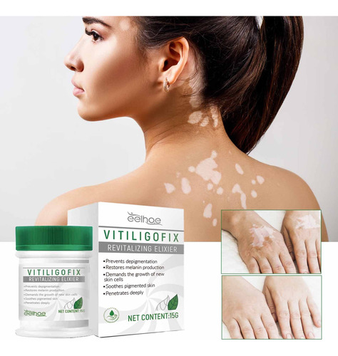 Crema B White Para Vitíligo, Psoriasis, Vitíligo Localizado