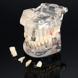 Prótesis De Implante Dental Modelo Maniquí