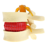 2x Modelo De Hernia De Disco Lumbar De La Columna Vertebral