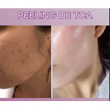 Ácido Retinoico+ Ácido Tca + Peeling 3d 