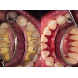 Limpieza Dental Con Ultrasonido+ Brochita + Flúor