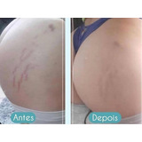 Peeling Ácido Glicolico 70% 30ml + Retinoico 40%  30 Ml