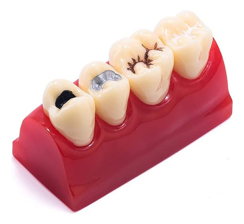 Modelo De Dientes De Patología Dental, Sellador, Demostració