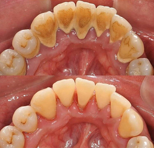 Limpieza Dental Con Ultrasonido Sarro Manchas
