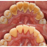Limpieza Dental Con Ultrasonido Sarro Manchas