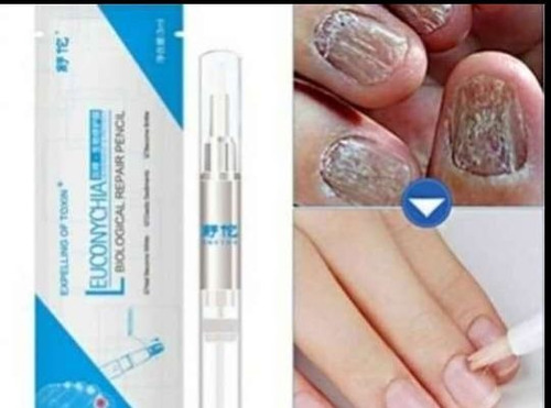 Anti Hongos Tratamiento De Uñas Onychomicosis Paroniquia