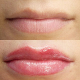 Micro/ Sobrancelhas + 1 Lips Hidra Gloss 