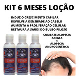 3 Loção Kit Anti Alopecia Areata Nasce Cresce E Fortalece!!!