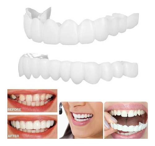 Prótesis Dental Superior E Inferior Snap On Smile