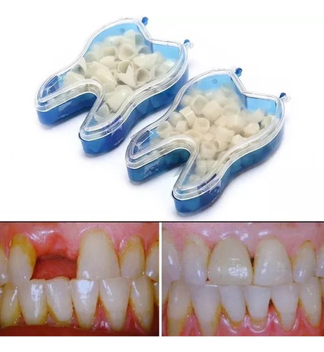 Dentes De Resina Postiço+massa Fixar. Avulso. A2. Provisório